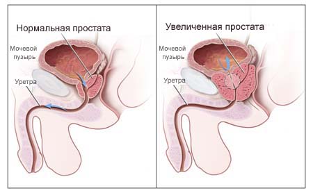 Простатит лечение не дорого