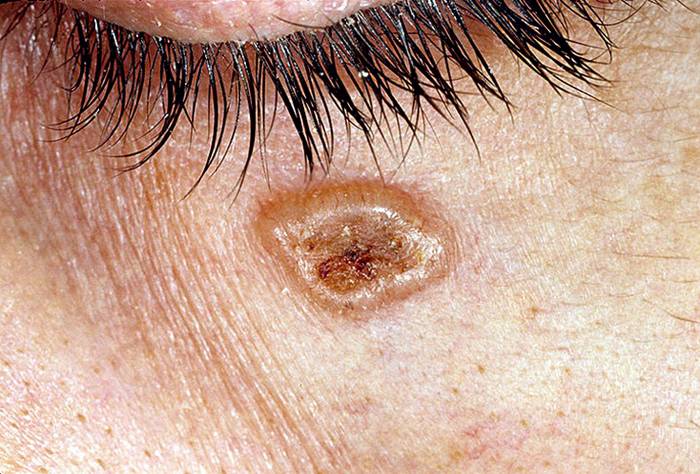 фото базально клеточный рак кожи