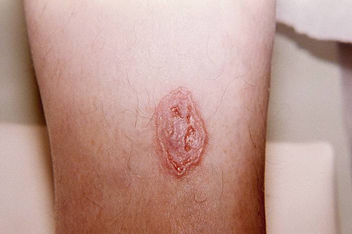 фото базально клеточный рак кожи