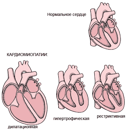 кардиомиопатия фото: кардиомиопатия