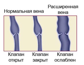 расширенные вены