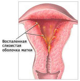 Как лечить бесплодие у женщин Твой гинеколог