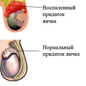 эпидидимит