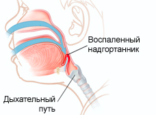 фото: эпиглоттит