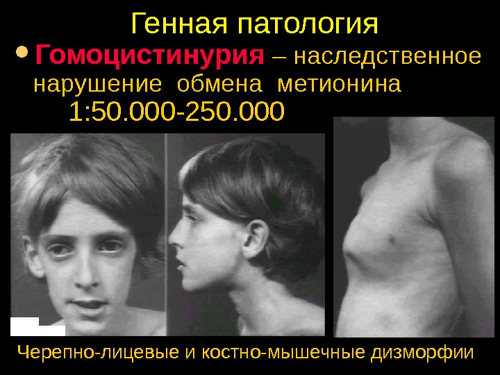 Цистинурия связана с Цистинурия связана с