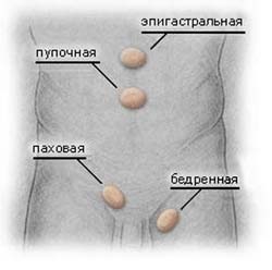 фото: расположение грыжи