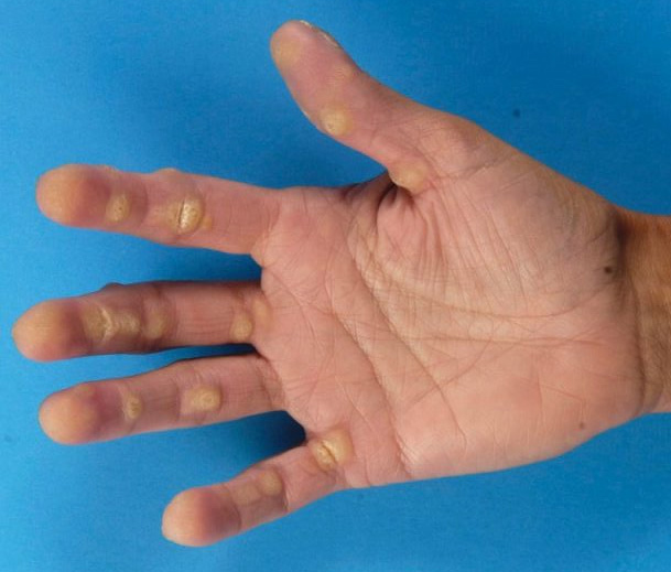 Гиперкератоз кожи виды, признаки, лечение