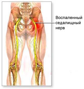воспаленный седалищный нерв фото: воспаленный седалищный нерв