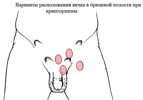 крипторхизм