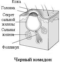 Акне: симптомы, диагностика, лечение Акне: симптомы, диагностика, лечение