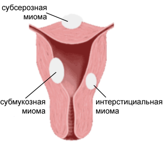 Миома матки фото: миома матки