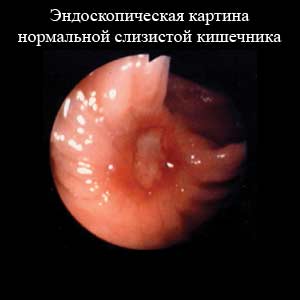 нормальная слизистая кишечника