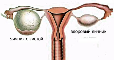 киста яичников фото онлайн