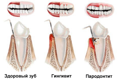 фото: пародонтит