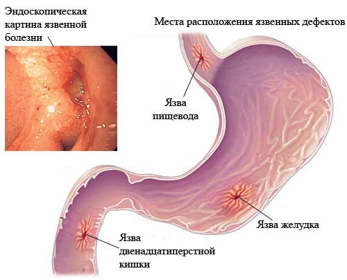 язвенная болезнь