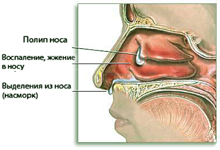 полипи в носа