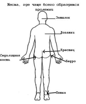 пролежни