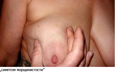 фото: проявления начальных стадий рака молочной железы