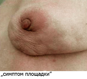фото: проявления начальных стадий рака молочной железы