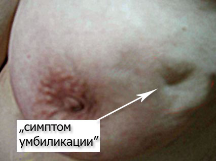 фото: проявления начальных стадий рака молочной железы