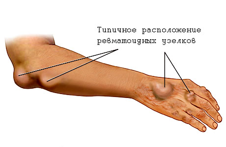 Ревматизм: симптомы, диагностика, лечение