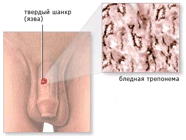 фото: сифилис 1-й стадии