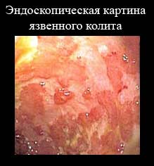 язвенный колит