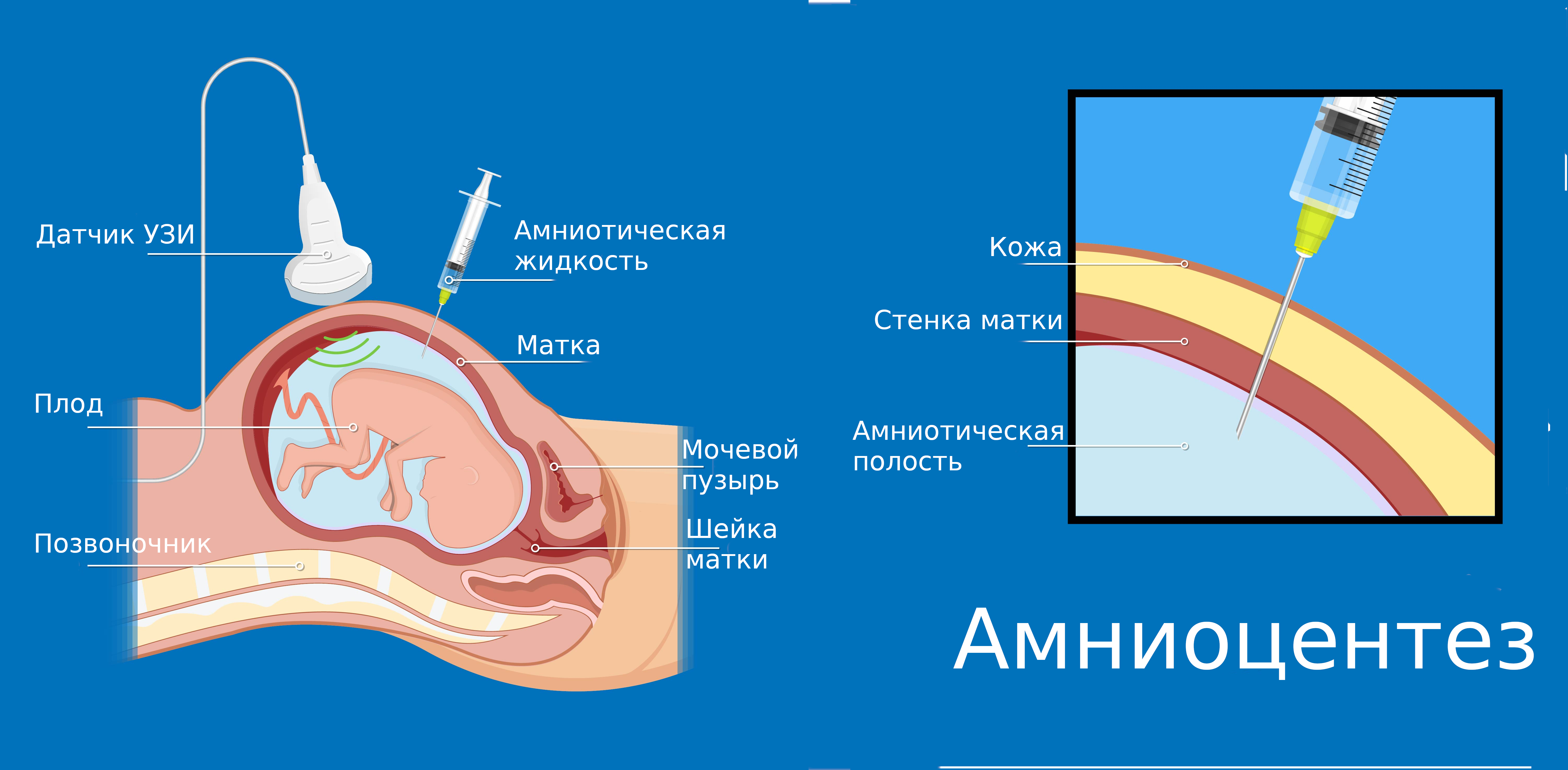 амниоцентез схема рисунок