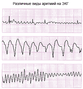 фото: виды аритмий на ЭКГ