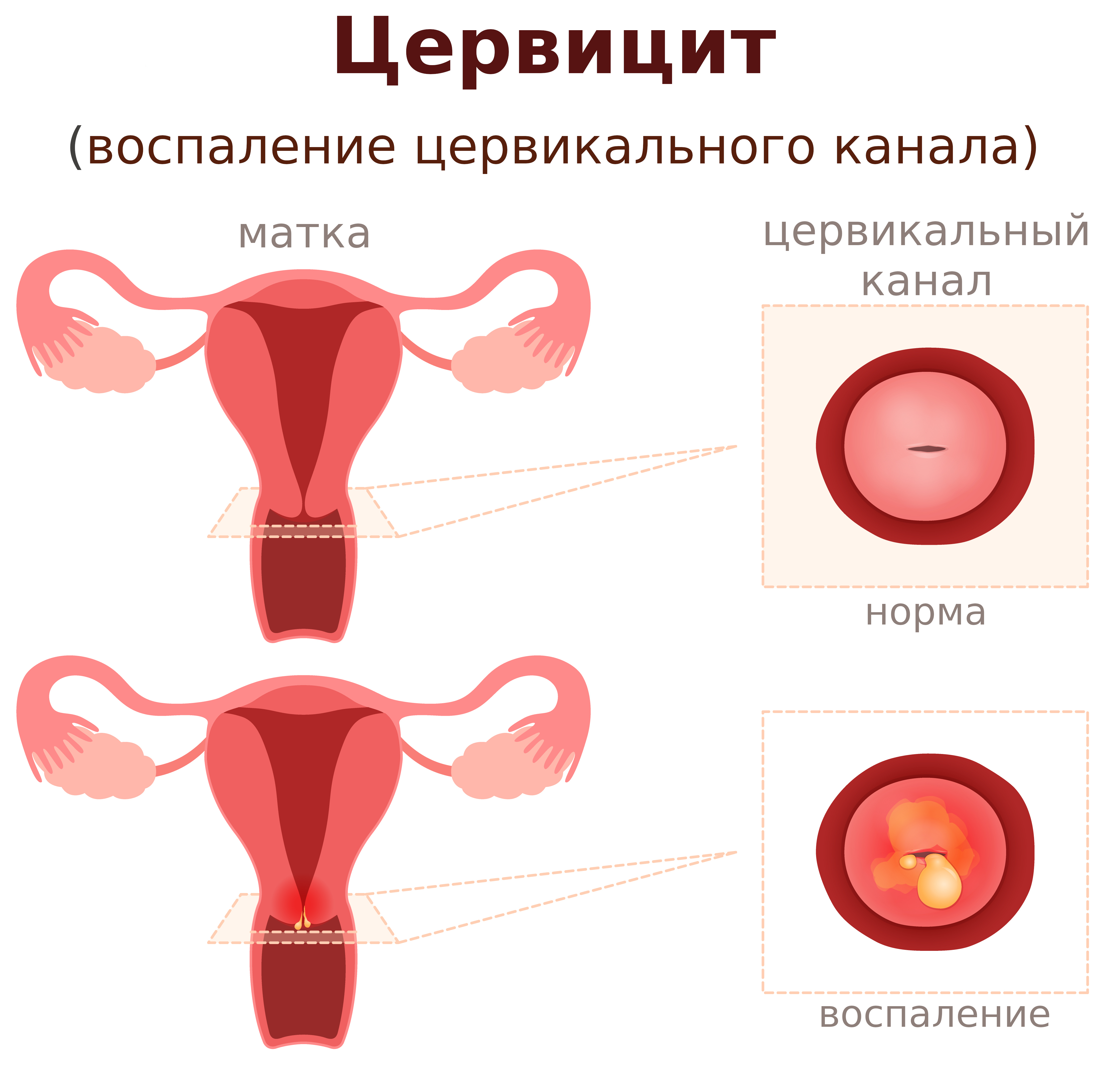 цервицит воспаление цервикального канала