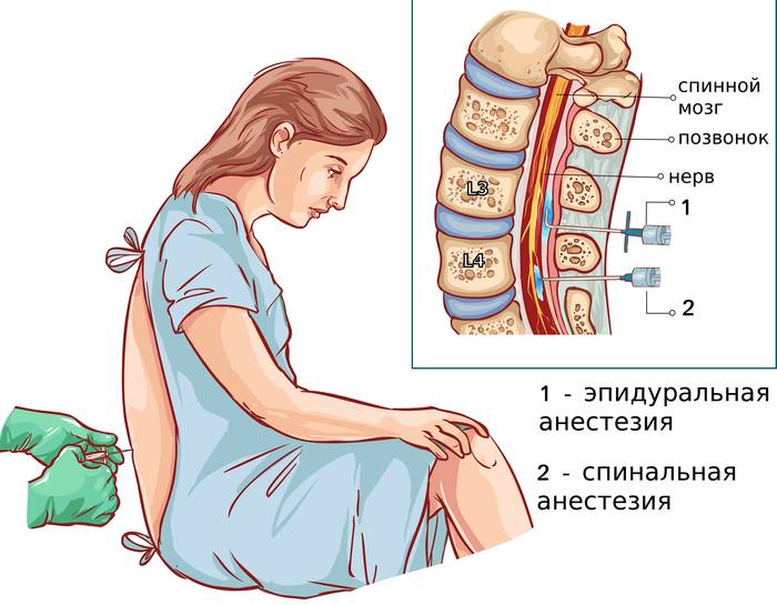 эпидуральная анестезия в родах