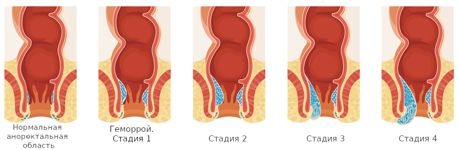 геморроидальные узлы по стадиям