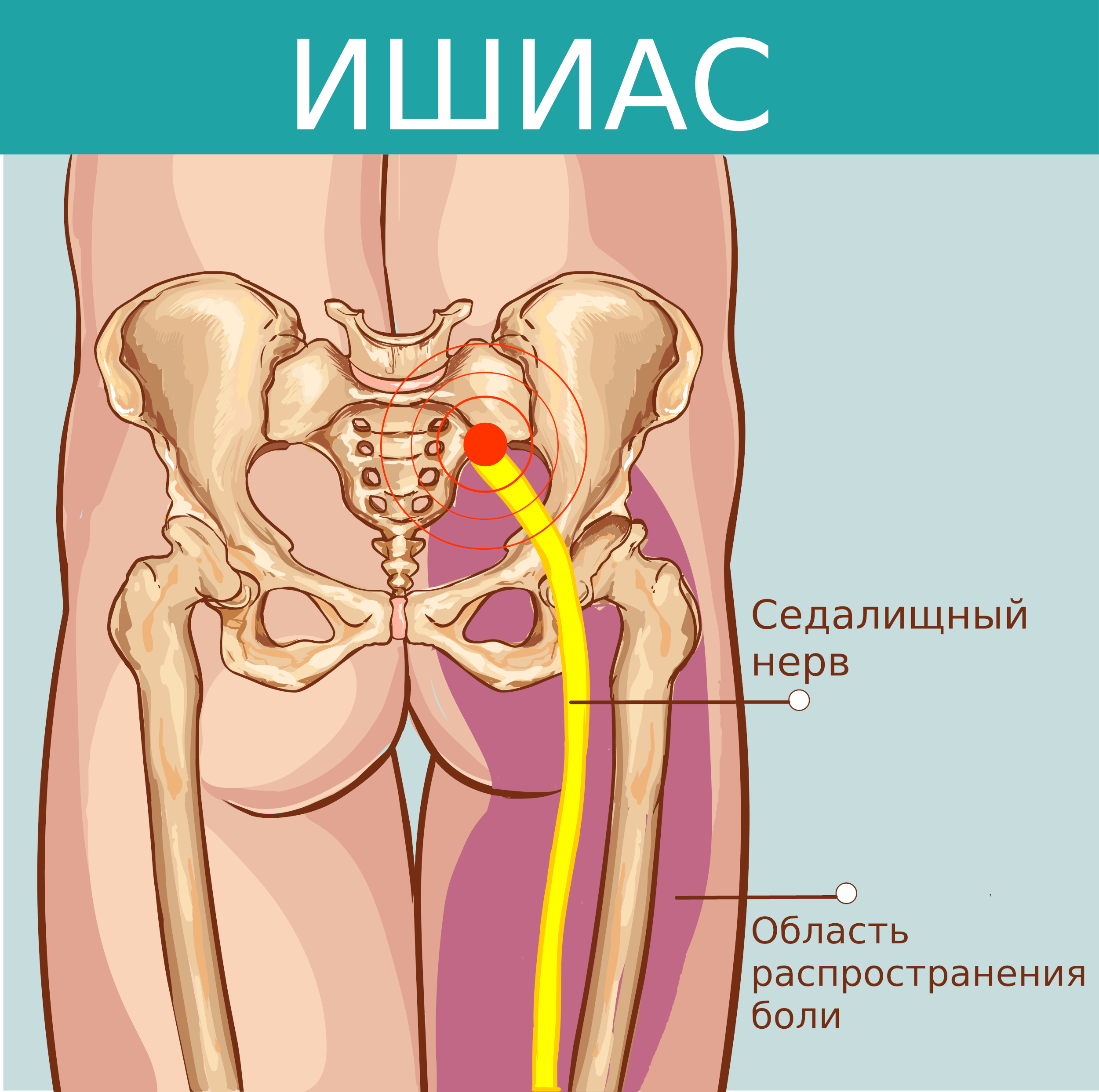 ишиас защемление седалищного нерва