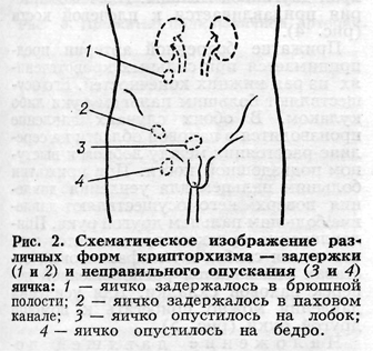 крипторхизм фото