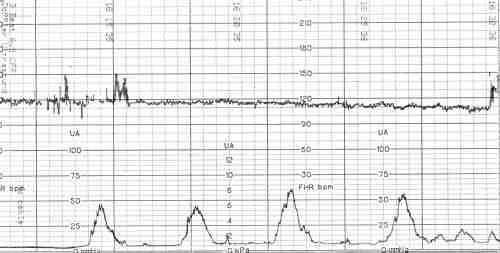 кардиотокограмма при КТГ плода