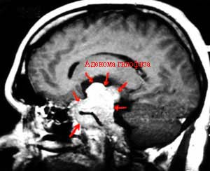 аденома гипофиза