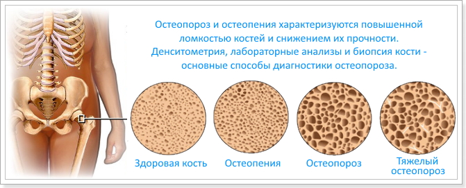 Изображение - Что такое остеопороз и остеоартроз суставов лечение osteoporoz_sustavov