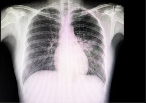 ревматический пневмонит на рентгенограмме