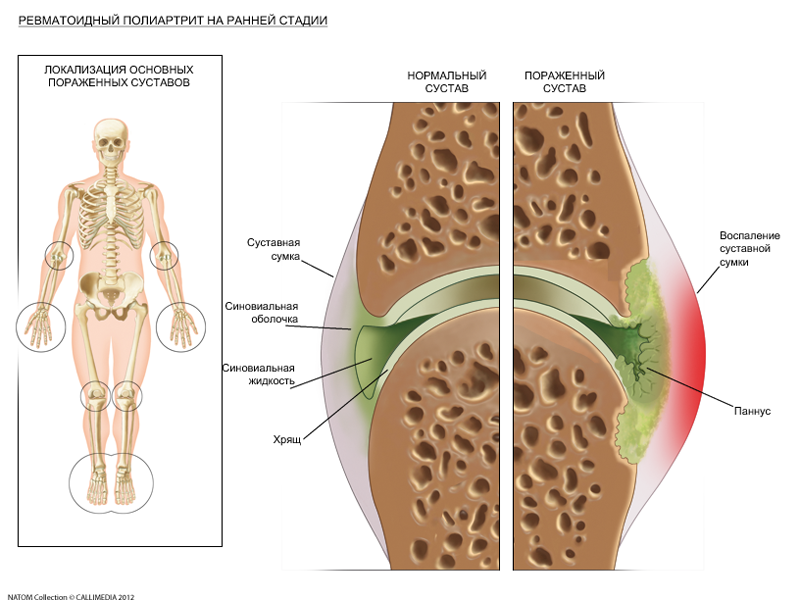 суставы, поражаемые на ранней стадии ревматоидного артрита
