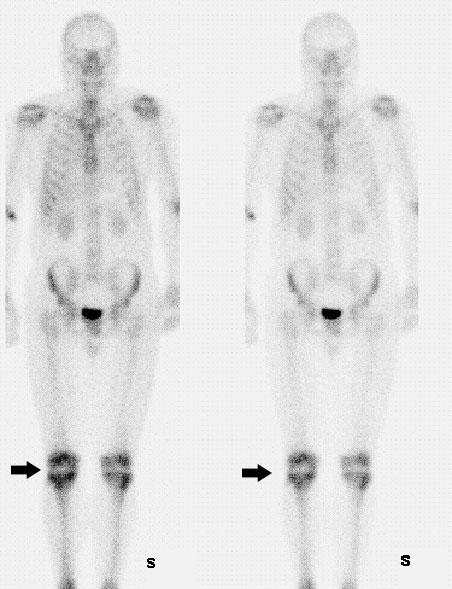 Сцинтиграфия полипозиционная костей