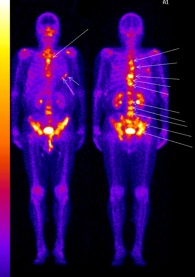 Сцинтиграфия полипозиционная костей