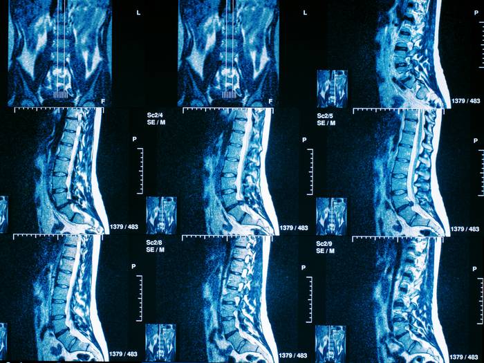 Для чего делают мрт спинного мозга