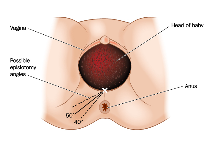 Эпизиотомия показания и противопоказания