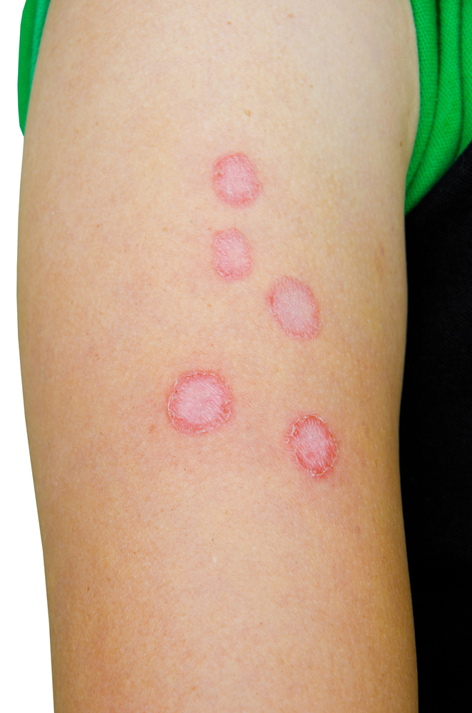 Лечение микроспории(микоза) гладкой кожи у человека