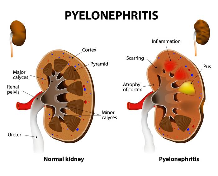 Пиелонефрит: эффективное лечение народными средствами