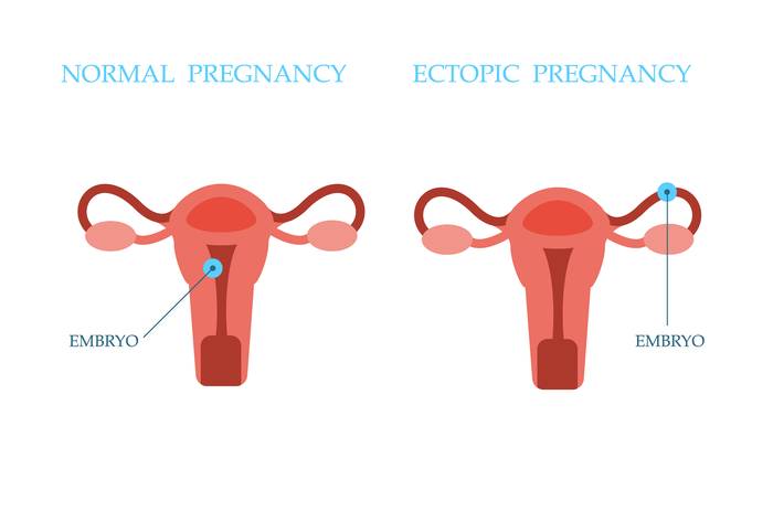 фото: локализация эмбриона при нормальной и внематочное беременности