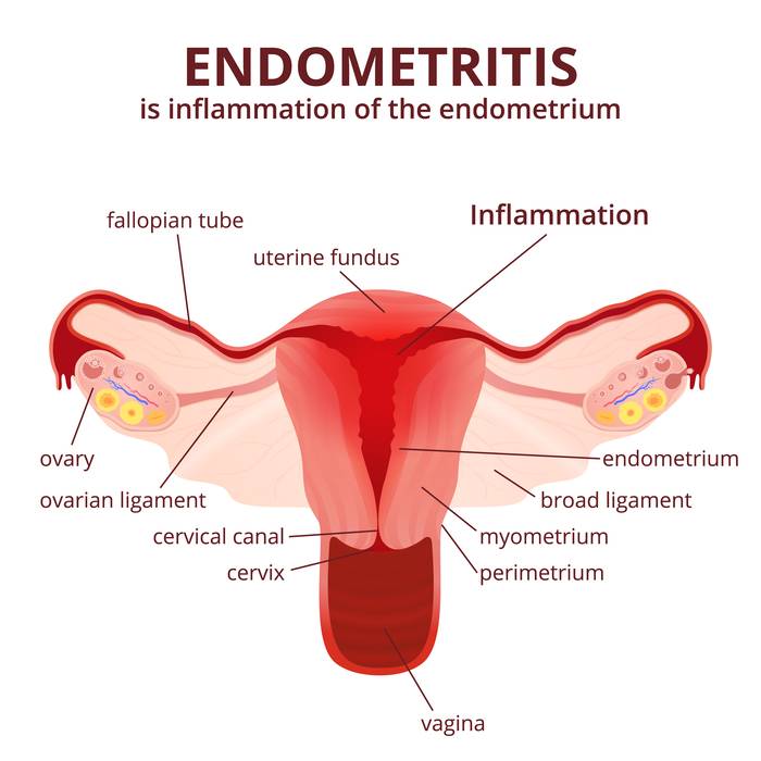 При эндометрите болит низ живота thumbnail
