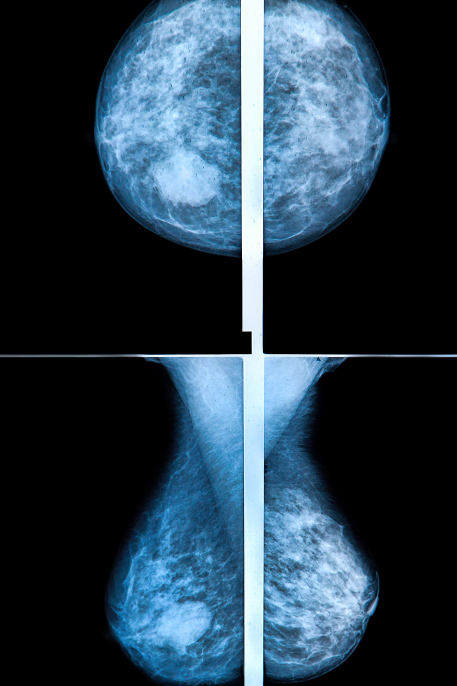 Маммография молочных желез - подготовка и результаты исследования