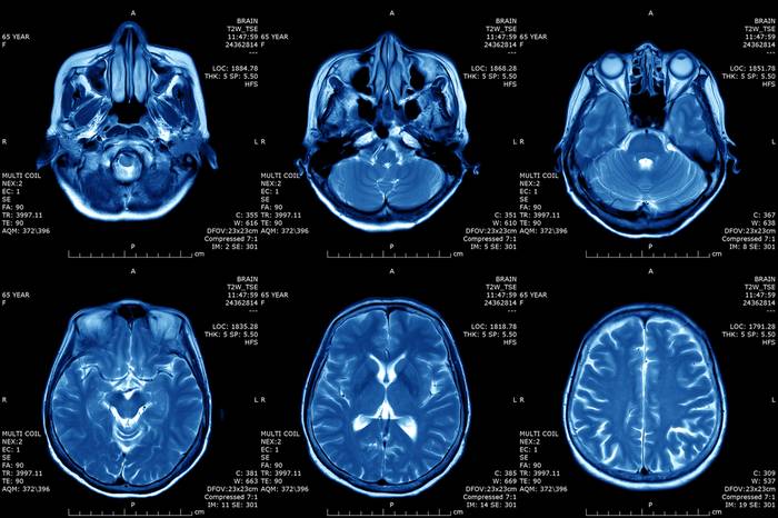 Результаты мрт головного мозга когда будут известны