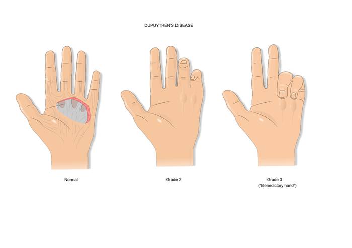 Контрактура Дюпюитрена: симптомы, диагностика, лечение